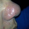 初期酒糟鼻是什么症状