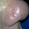 酒糟鼻不同时期有什么不同症状