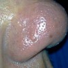 患酒糟鼻怎么治好