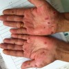 急性梅毒的症状有什么