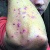 传播性女性梅毒的症状