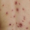 二期梅毒的皮肤损害有哪些
