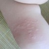 春季怎样预防皮肤过敏