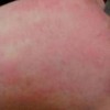 面部皮肤过敏症状