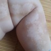 小儿皮肌炎图片