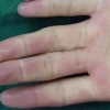 皮肌炎的诊断特点