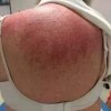 幼儿皮肌炎的症状都有什么呢