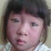 皮肌炎有哪些特点呢