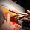 青岛治疗腋臭多钱