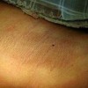 青岛治疗腋臭价钱