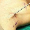 青岛治疗腋臭多少钱呢