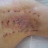 青岛女性腋臭要如何治疗