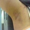 青岛治疗腋臭专科医院