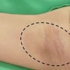 青岛治疗腋臭要多少钱