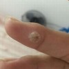 寻常疣的有效预防措施