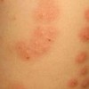 专家讲解荨麻疹的危害具体有哪些表现