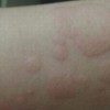 治疗荨麻疹的过程中要注意一些事项