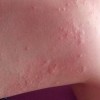 怎么治疗胆碱性荨麻疹