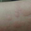 针灸治疗丘疹性荨麻疹怎么样
