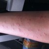 治疗丘疹性荨麻疹好的医院