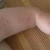 治疗荨麻疹最好的医院在哪里