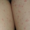 治疗荨麻疹的措施是什么