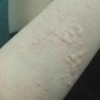 治疗荨麻疹的特效药
