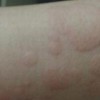 治疗荨麻疹用什么药