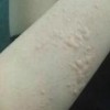 最好慢性荨麻疹治疗的手法
