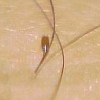 预防阴虱需要怎样的