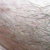 阴虱怎么治疗