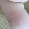 预防皮肤过敏要做好哪些
