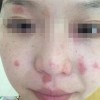 女性怎样的预防皮肤过敏
