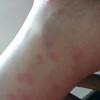 怎样的预防皮肤过敏