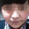 皮肤过敏的常见症状