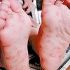 病毒性疱疹症状有什么