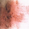 口唇单纯疱疹的临床症状有哪些