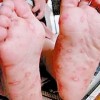 单纯疱疹可通过哪些表现确诊