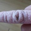 系统性硬皮病的主要症状