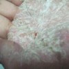 额头带状硬皮病的症状