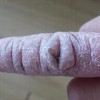 免疫性硬皮病的症状有什么
