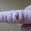 患有硬皮病该如何治疗呢