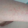 宝宝秋季皮肤过敏所表现的症状