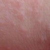 季节性皮肤瘙痒怎样的预防