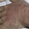 老年人患有皮肤瘙痒 如何查清楚病因