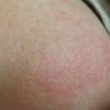 常见脂溢性皮炎的护理