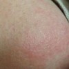 青岛常见脂溢性皮炎的治疗好方法