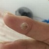 寻常疣去哪里治疗最好