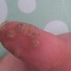 寻常疣的预防