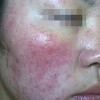 接触性皮炎用什么药膏